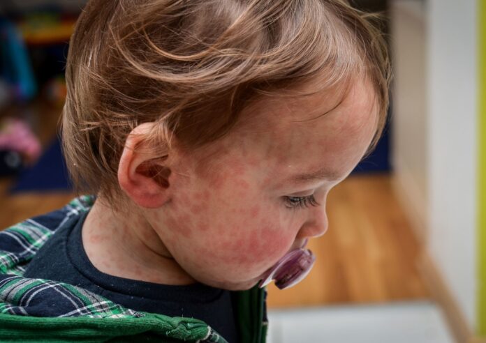 Child with measles